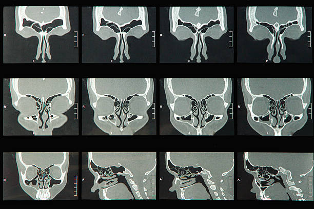 Sinus MRI MRI scan of the human sinus with Nasal Passages cnidarian stock pictures, royalty-free photos & images