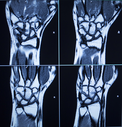 MRI magentic resonance imaging nuclear scanning scan test results wrists hands injury photo.