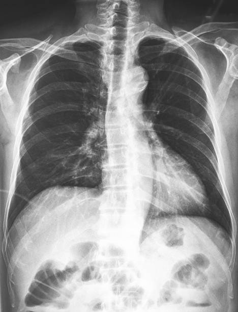 istock X-ray of the chest 535916621