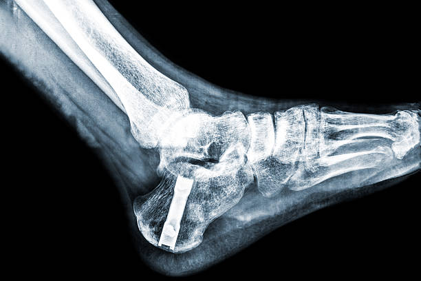 x-ray of der ferse nach fersenbein knochenbruch - bending human foot ankle x ray image stock-fotos und bilder