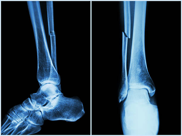 Fracture shaft of fibula bone ( leg bone ) Fracture shaft of fibula bone ( leg bone ) . X-ray of leg ( 2 position : side and front view ) x ray tarsal ankle and foot stock pictures, royalty-free photos & images