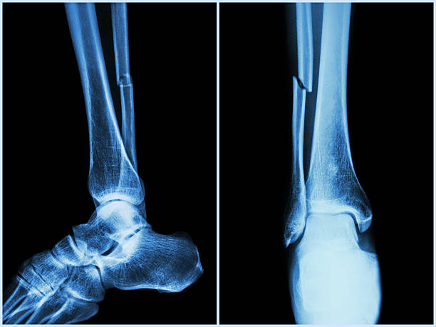 Fracture shaft of fibula bone ( leg bone ) Fracture shaft of fibula bone ( leg bone ) .  X-ray of leg ( 2 position : side and front view ) fibula stock pictures, royalty-free photos & images