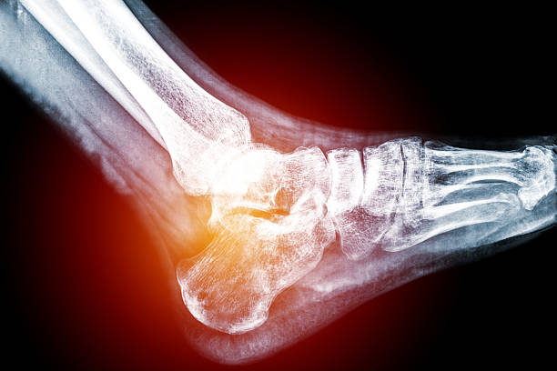 schmerzhaften ferse x-ray menschlicher fuß - bending human foot ankle x ray image stock-fotos und bilder