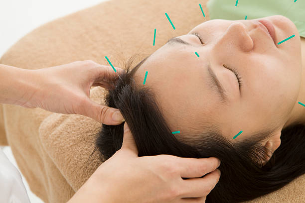 istock Woman receiving massaging a head while acupuncture treatment 536879009