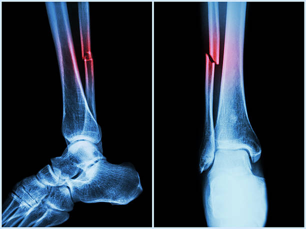 Fracture shaft of fibula bone ( leg bone ) Fracture shaft of fibula bone ( leg bone ) . X-ray of leg ( 2 position : side and front view ) x ray tarsal ankle and foot stock pictures, royalty-free photos & images
