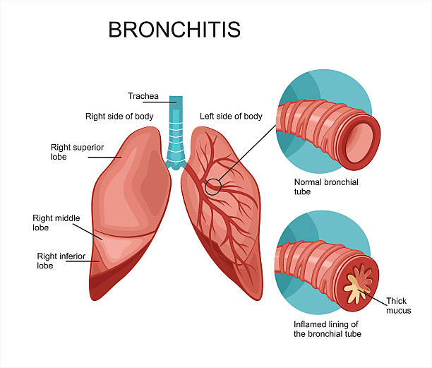 Bronke 460+ Inflamed Bronchial Tubes Stock Illustrations, Royalty-Free Vector ...