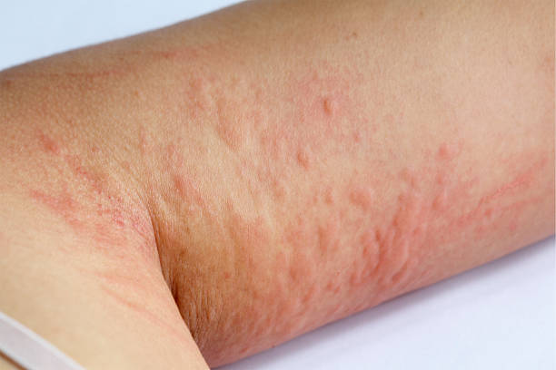 istock allergic rash skin of patient upper arm 537324350
