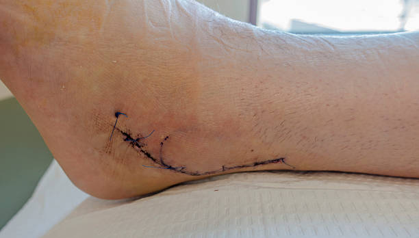 broken left ankle bloody stitches orthopedic surgery post-op doctor office - podiatrist podiatry orthopedic surgeon human foot imagens e fotografias de stock