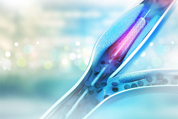 스텐트 심장동맥성형술 절차를 풍선 걸기 - angioplasty 뉴스 사진 이미지