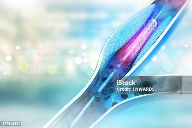 Stent Angioplasty Procedure With Placing A Balloon Stock Photo - Download Image Now - Stent, Angioplasty, Surgery