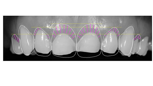Digital Smile Design Foto of Digital Smile Design protocol. Black and white dental phoo with markings in color. gingivoplasty stock pictures, royalty-free photos & images