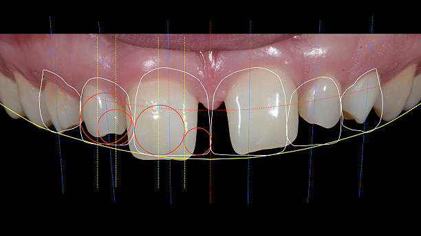 Digital Smile Design Foto of Digital Smile Design protocol. Dental photo with markings in color. gingivoplasty stock pictures, royalty-free photos & images