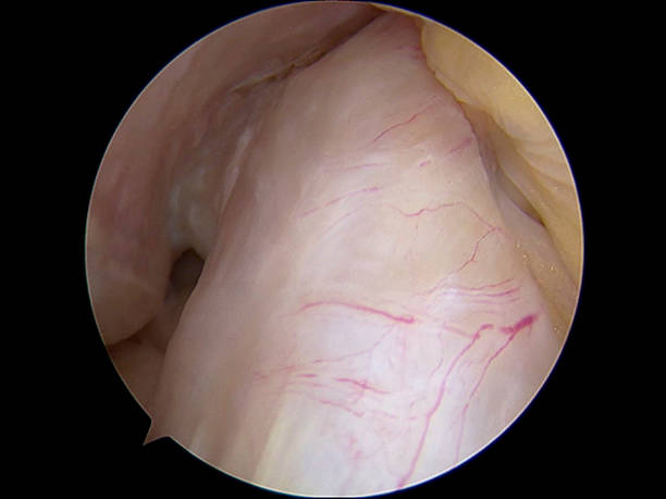 Arthroscopic view of anterior cruciate ligament (ACL) of the knee Arthroscopic view of the proximal part of anterior cruciate ligament - ACL - of the right knee. The femur (where the ACL insert) is seen in the upper-left corner. posterior cruciate ligament stock pictures, royalty-free photos & images