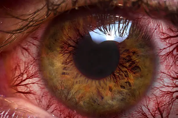 Macro close up red bloodshot eyeball for allergy imagery