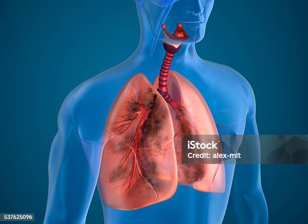Diseased Lungs Xray View Stock Photo - Download Image Now - Pneumonia, Anatomy, Biology
