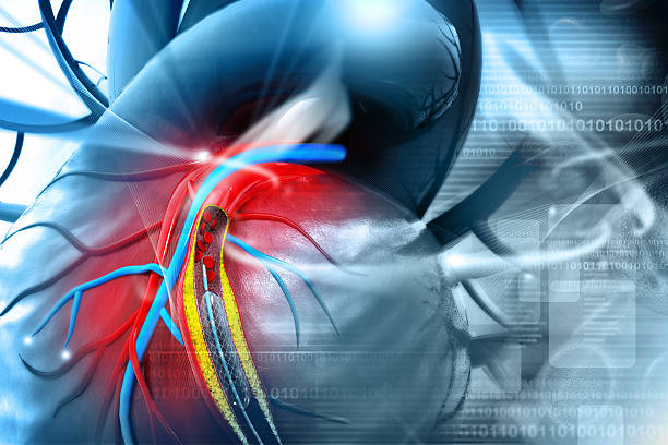 Stent angioplasty stock photo