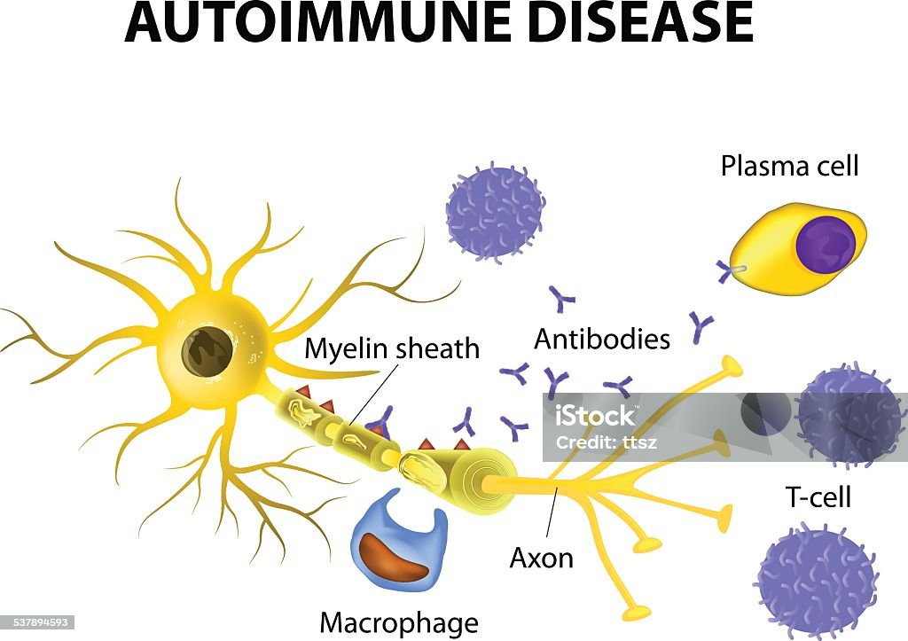 Autoimmune Disease. The mechanisms of neuronal damage in multiple sclerosis Autoimmune Disease. Multiple sclerosis - Immune cells attack the myelin sheath that surrounds nerve cells.  Antibodies initiate myelin injury (macrophage activation). Multiple Sclerosis stock vector