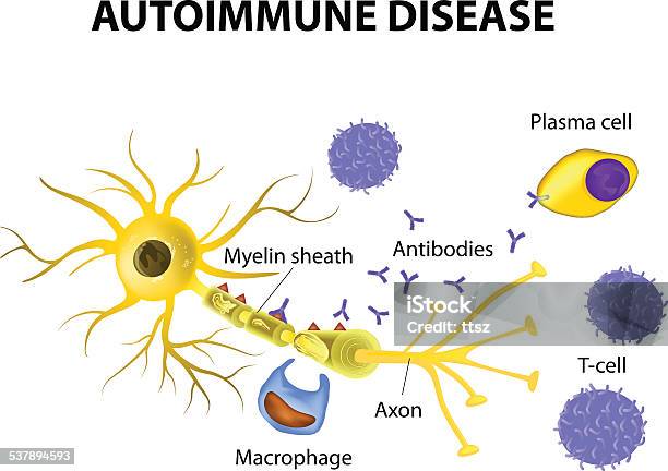 Autoimmune Disease The Mechanisms Of Neuronal Damage In Multiple Sclerosis Stock Illustration - Download Image Now
