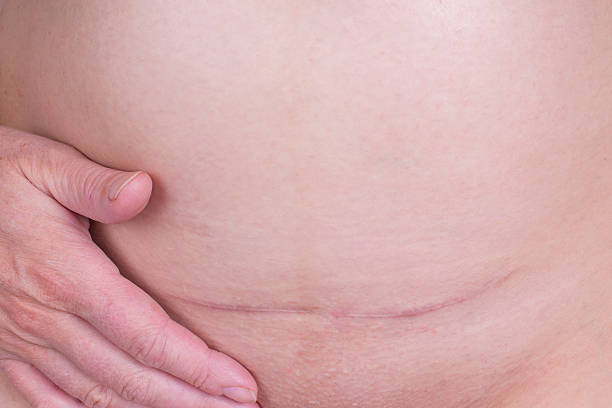 C section scar Scar after a Caesarean section, Bikini line scarification stock pictures, royalty-free photos & images