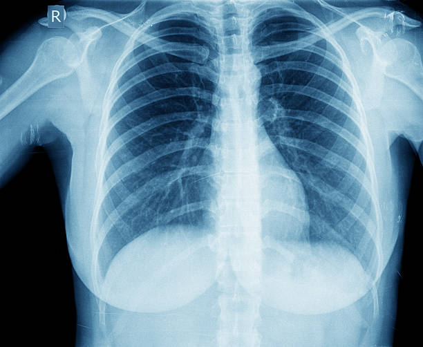 рентгенография грудной клетки изображение - healthcare and medicine human heart abdomen human spine стоковые фото и изображения