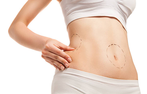 patient with outlines on body in close-up - liposuction imagens e fotografias de stock