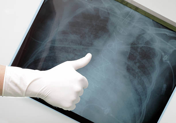 pulgar arriba en el fondo de rayos x de los pulmones. - x ray image radiologist examining using voice fotografías e imágenes de stock
