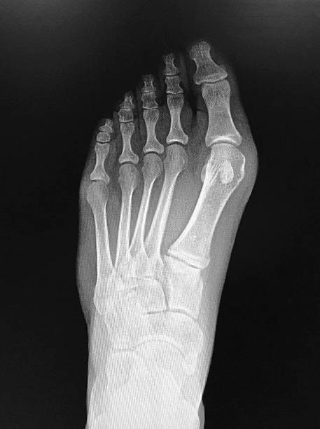 radiografie del piede con alluce valgo - human foot bunion pain human toe foto e immagini stock