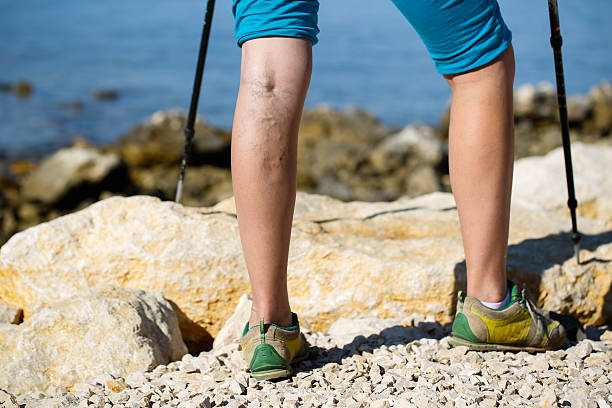 varicose veins - woman legs veins stockfoto's en -beelden