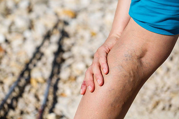 Painful varicose veins Woman touching painful varicose veins on a leg blood clot photos stock pictures, royalty-free photos & images