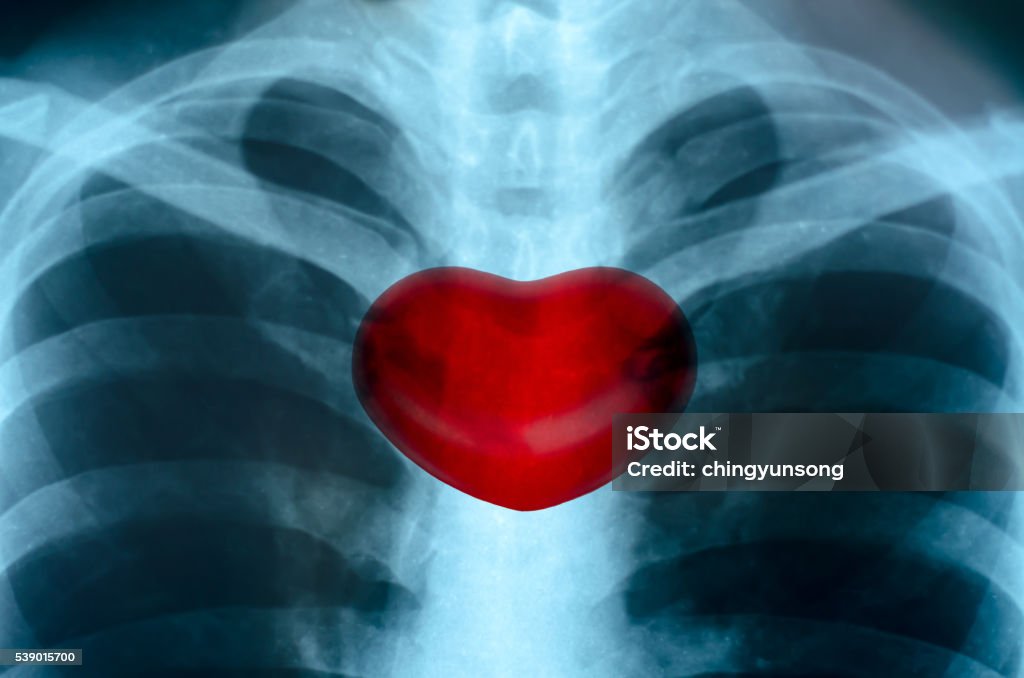 Imagem de raios X Close-up do Homem do peito - Foto de stock de Asmático royalty-free