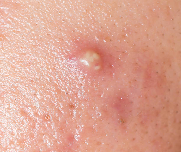 istock pimple or acne  abcess closeup 539087412