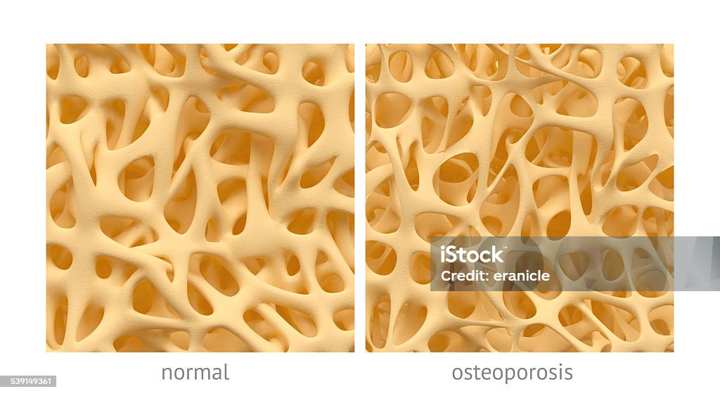 Osteoporosis Bone spongy structure close-ups, normal and with osteoporosis Osteoporosis Stock Photo