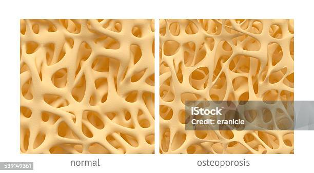 Osteoporosis Stock Photo - Download Image Now - Osteoporosis, Animal Bone, Cross Section