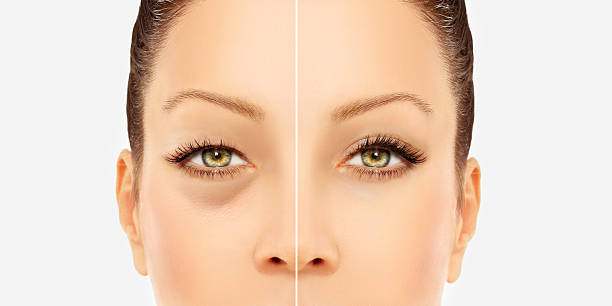 istock Lower Blepharoplasty.Upper blepharoplasty 539205616