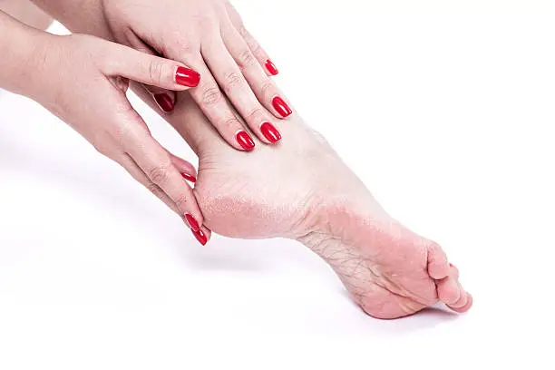 Photo of dehydrated skin on the heels of female feet with calluses