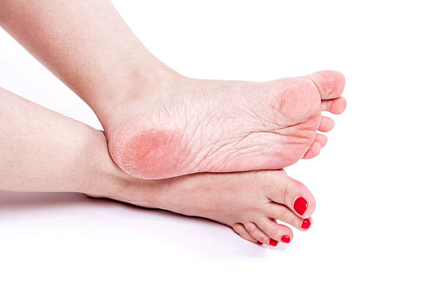 istock dehydrated skin on the heels 539222590