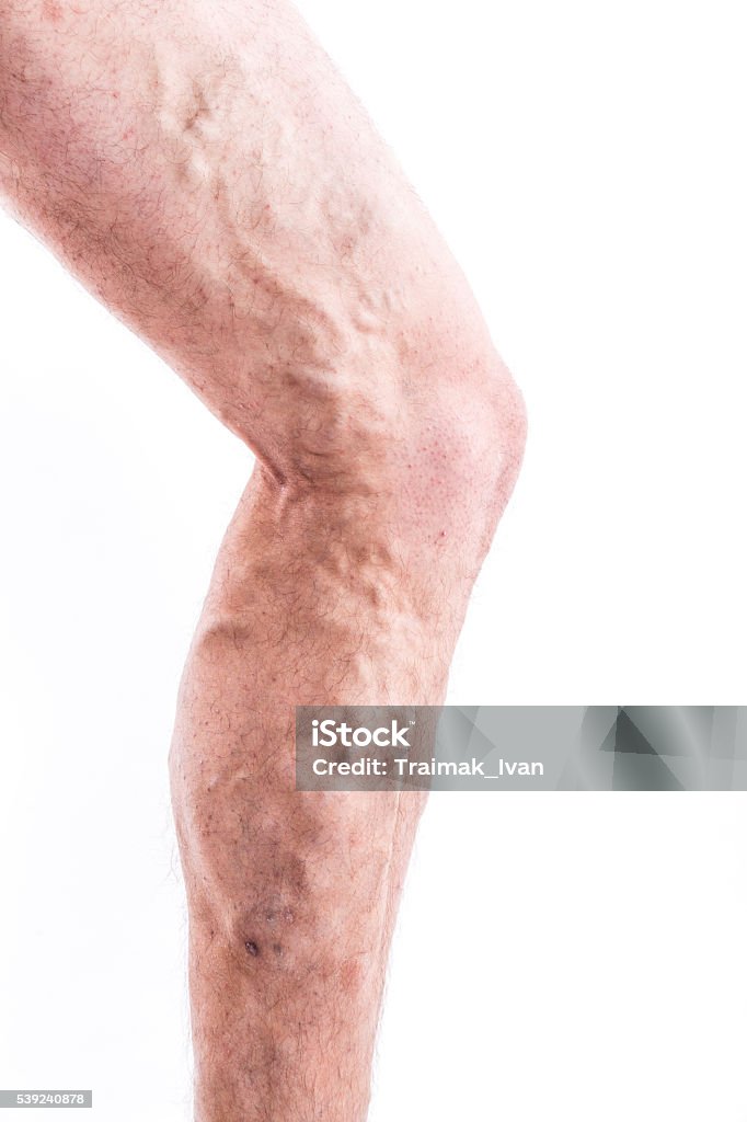 Hombre con venas varicosas de las extremidades inferiores y venosos - Foto de stock de Araña libre de derechos