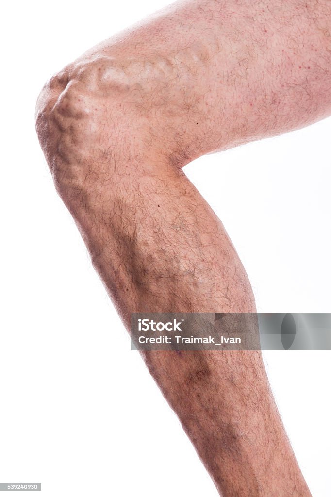 Hombre con venas varicosas de las extremidades inferiores y venosos - Foto de stock de Araña libre de derechos