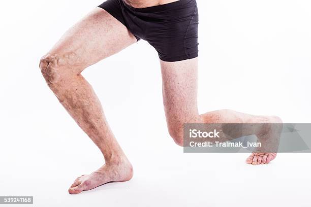 Hombre Con Venas Varicosas De Las Extremidades Inferiores Y Venosos Foto de stock y más banco de imágenes de Araña