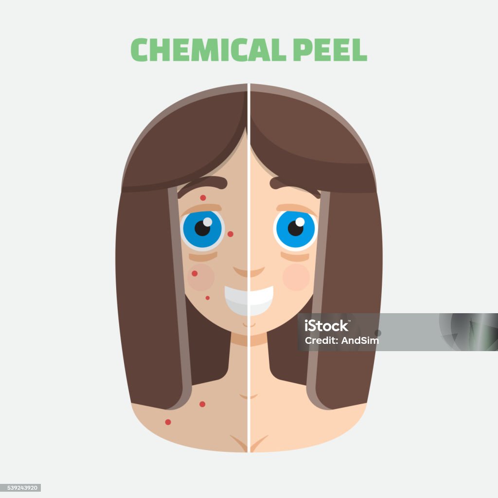 Química de piel - arte vectorial de Acné libre de derechos