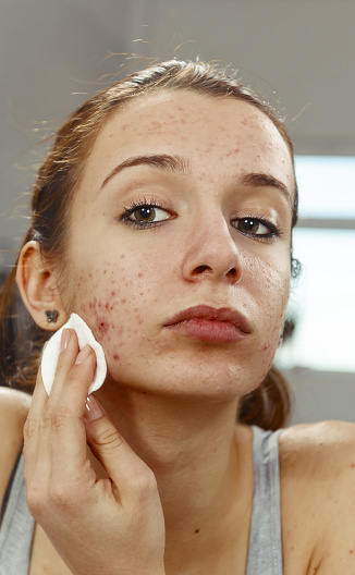 teenager with acne cleaning her skin.