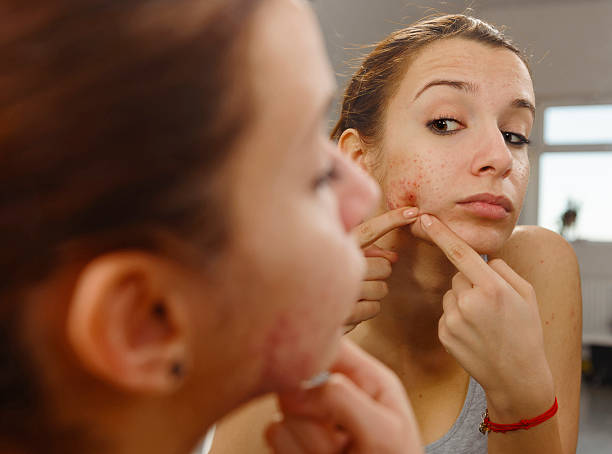 istock acneic woman with irritation on face 539257387
