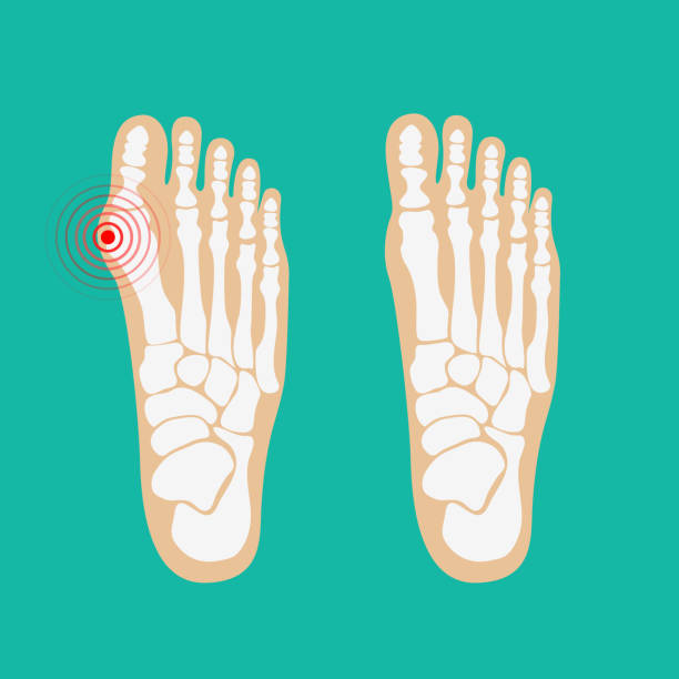 valgusova deformita velkého hrotu. zdravotní péče o nohy. - noha část těla stock ilustrace