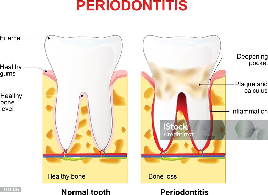 Periodontitis or pyorrhea Periodontitis is a inflammatory diseases affecting the periodontium, the tissues that surround and support the teeth Dental Health stock vector