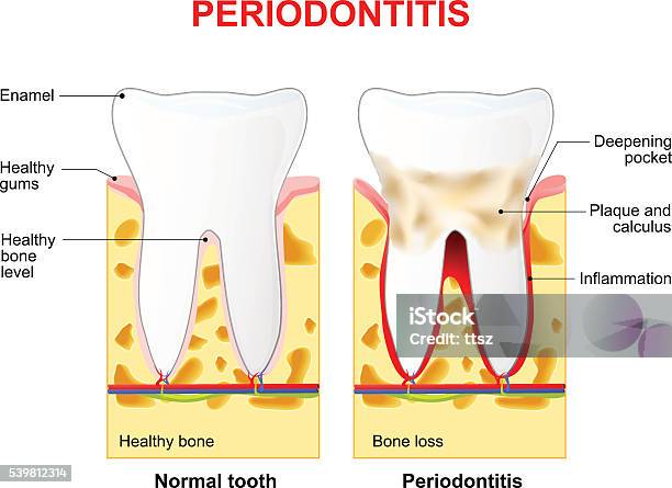 Periodontitis Or Pyorrhea Stock Illustration - Download Image Now - Dental Health, Abscess, Anatomy