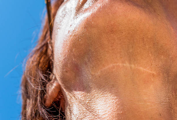 chirurgical cou scar - prominence photos et images de collection