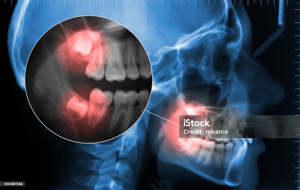 kephalometrischen und zeigt Zahnschmerz Weisheit Zahn - Lizenzfrei Berufliche Beschäftigung Stock-Foto