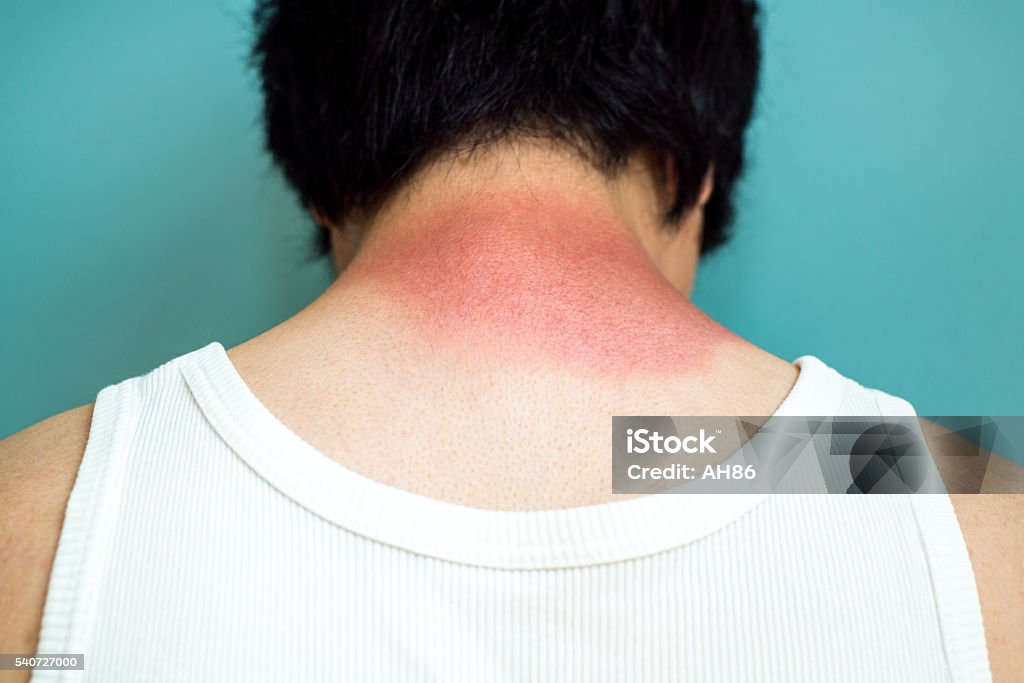 Quemaduras de sol - Foto de stock de Actividades recreativas libre de derechos