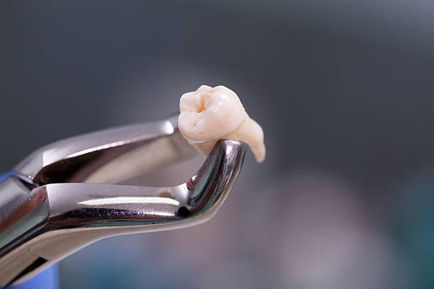 dental equipment,tooth extraction - pliers imagens e fotografias de stock