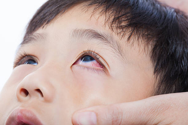 클로즈업 핑크아이(결막염) 감염 - conjunctivitis sore eyes child human eye 뉴스 사진 이미지